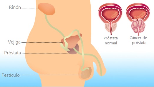 ¿Próstata intocable? No para el cáncer