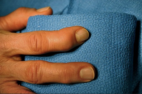 Artritis, Articulaciones, Salud