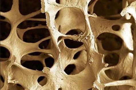 Osteoporosis, Huesos, Huesos frágiles, Fracturas