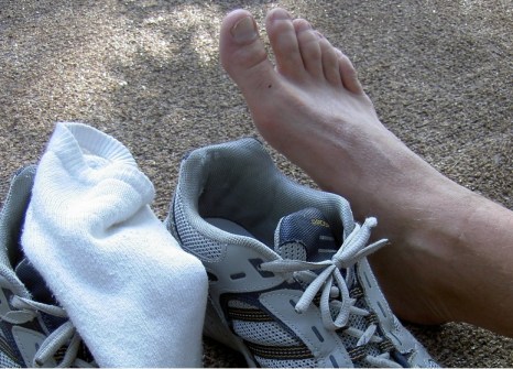 Sudor en los pies, Hiperhidrosis plantar