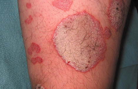 Psoriasis, Lesiones en la piel, Piel